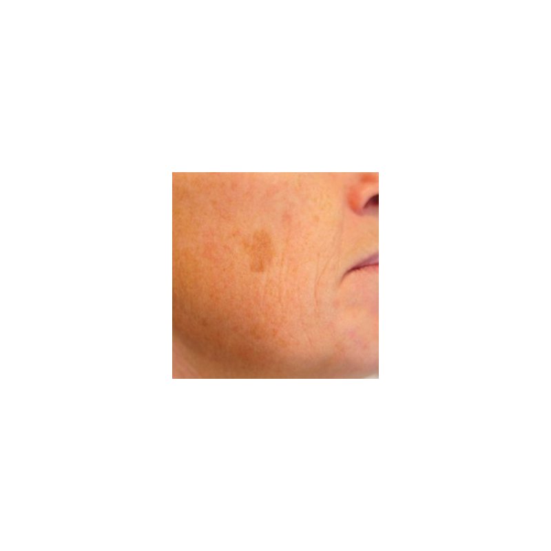 cryoiq_derm_plus_cryotherapy_kit_zone_medical_brown_spot_removal_treatment_300x300.jpg