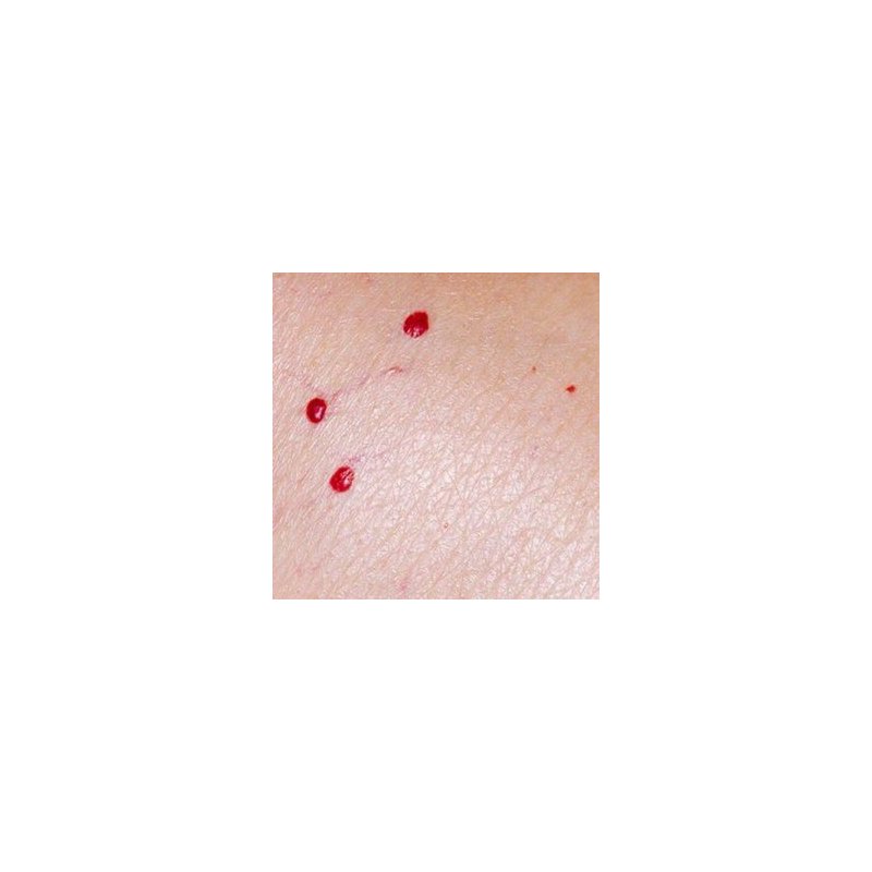 cryoiq_derm_plus_cryotherapy_kit_zone_medical_cherry_angioma_removal_treatment_300x300.jpg
