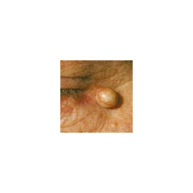 cryoiq_derm_plus_cryotherapy_kit_zone_medical_sebaceous_cyst_removal_treatment_300x300.jpg
