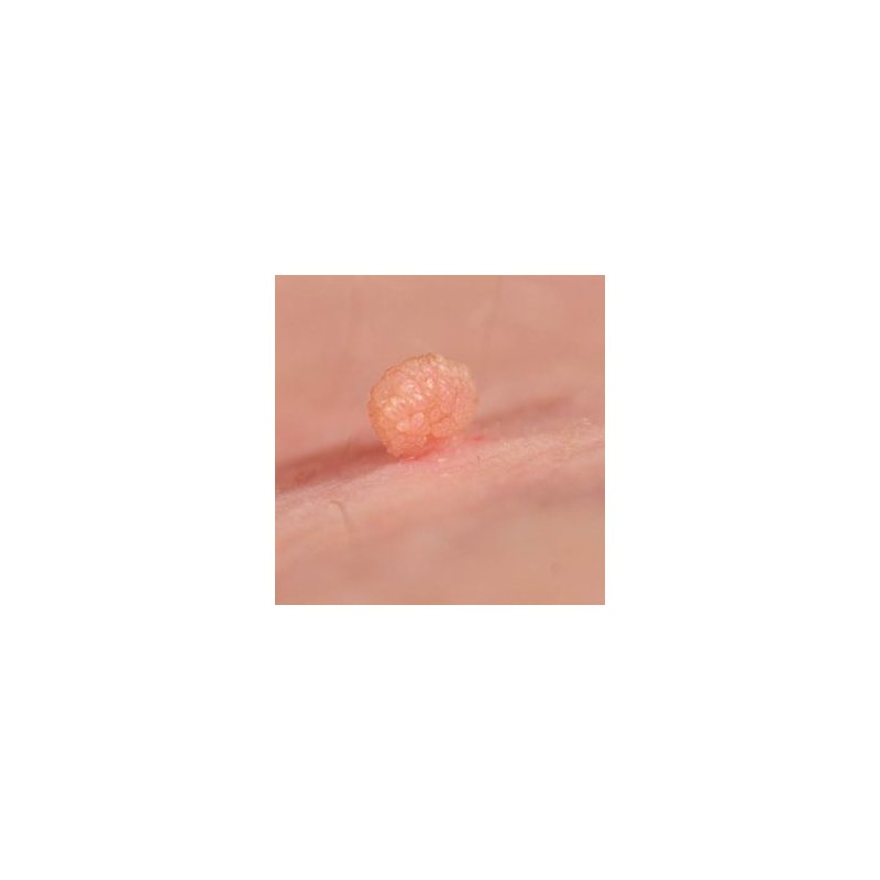 cryoiq_derm_plus_cryotherapy_kit_zone_medical_skin_tag_removal_treatment_300x300.jpg