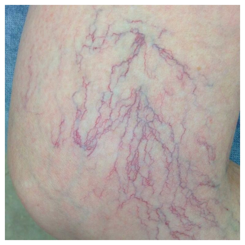 cryoiq_derm_plus_cryotherapy_kit_zone_medical_spider_vein_768x768.jpg
